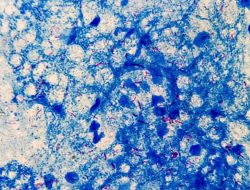 Viral Klaim Herbal Sembuhkan TBC, Dokter: Tidak Terbukti